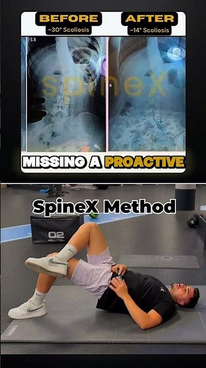 How to reduce scoliosis