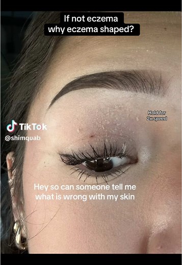 Understanding Seborrheic Dermatitis: Causes and Treatments