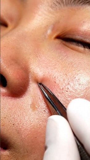 🤯 HUGE Blackheads Removed! 😱 You Won't Believe What Comes Out! 👃