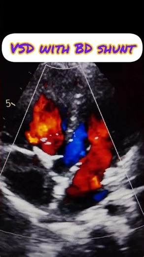 VSD with BD shunt#Large BD shunt