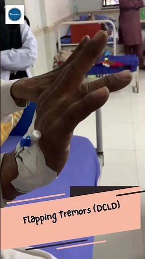Dr Medica Clinical Case || Flapping Tremors || Clinical Medicine