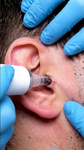 Professional Behind Ear Blackhead Removal | ASMR