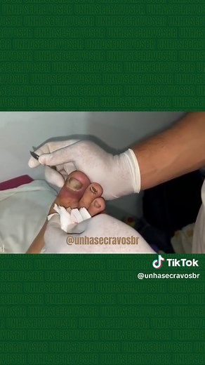 Ingrown toenail 💅🏻 #ingrowntoenail #foryou #viral #pimples #pimplepooping #satisfyingvideo #espinas #fyp