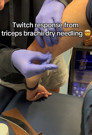 Using dry needling to target deep triceps tension, watch the twitch responses! #dryneedlingtherapy #dryneedling #triceps #triggerpoint