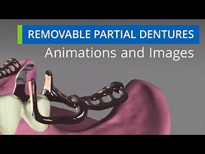 Removable Partial Dentures Animations & Images