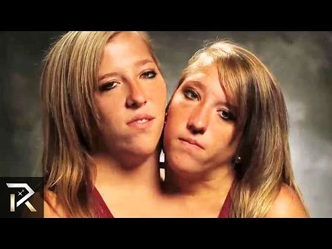 The Most Amazing Conjoined Twins