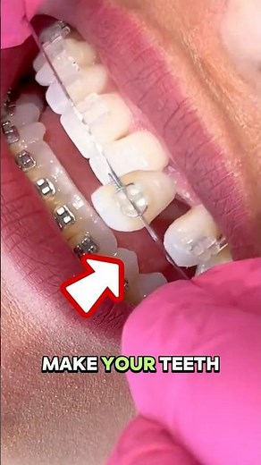 Can Braces Make Your Teeth Fall Out?