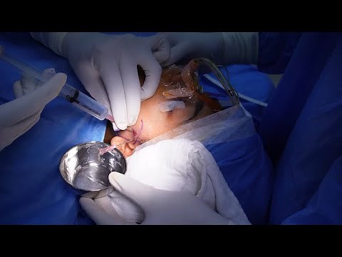 Tmj Arthrocentesis - Joint Pain Relief - Complete Procedure