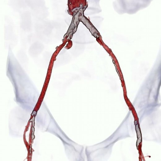 virtual kissing stents