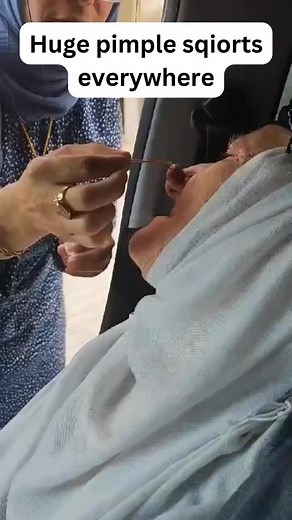 467K views · 1.2K reactions | Huge one on the nose! #trendingreelsvideo | The Best Pimple Popping Videos | Facebook