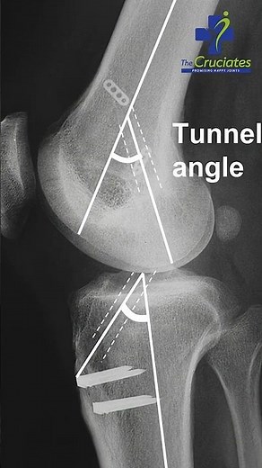 ACL Surgery के लिए Tunnel कैसे बनाए जाते हैं? | ACL Surgery | Ligament Surgery