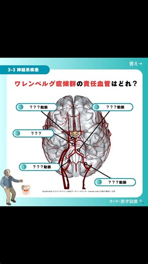 ワレンベルグ症候群 脳血管 #解剖学 #理学療法士国家試験 #作業療法士国家試験