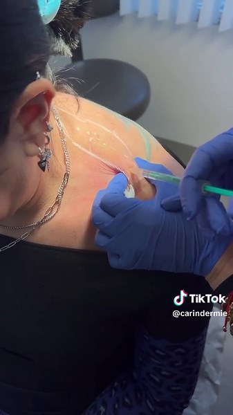 What is #TrapTox? TrapTox, aka “#BarbieBotox,” is the Botox trend you may have seen on social media lately. It’s influenced by #Barbie’s slim, elongated neck. It involves injecting the trapezius muscle—the area extending over the back of the neck and shoulders—and it not only delivers aesthetic benefits but also releases tension that causes aches and pains or headaches. It is similar to #masseterBotox. The #neurotoxin blocks the signal from the nerves to the muscle, so if you try to flex the mus