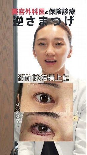 下まつ毛が目に刺さる方、逆さまつ毛は保険適応で治療できます！