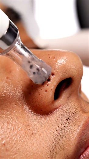 “The Most Satisfying Blackhead Removal You’ll Ever Watch!”
