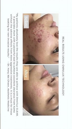 Omnilux LED Light Therapy Mask: Anti-Aging & Skin Rejuvenation | At-Home LED Treatment