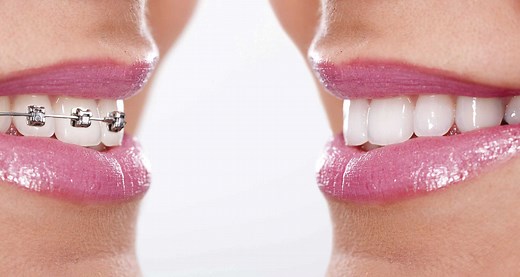 Las 7 fases o etapas de la ortodoncia