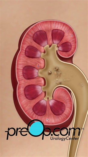 🔍 PreOp® Kidney Stone Lithotripsy ESWL 💡 Preventing Future Stones ✨ #shorts