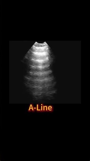 Understanding A-Lines on Lung Ultrasound (Normal Finding) #sonography #ultrasound #sonographer