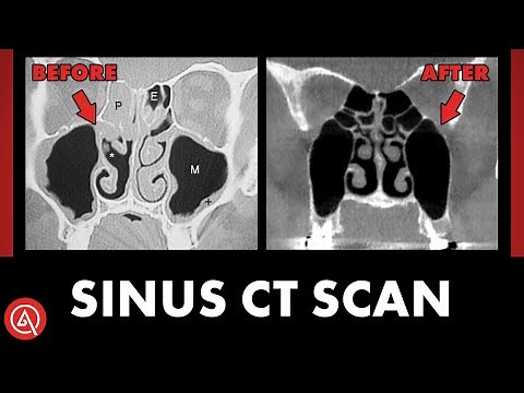 The Power and Insight of Sinus CT Scans