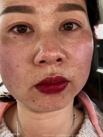 Cream Chalones: Brightening & Freckle Removal Tips