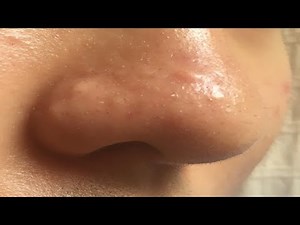 how to get rid of nose acne bumps easy
