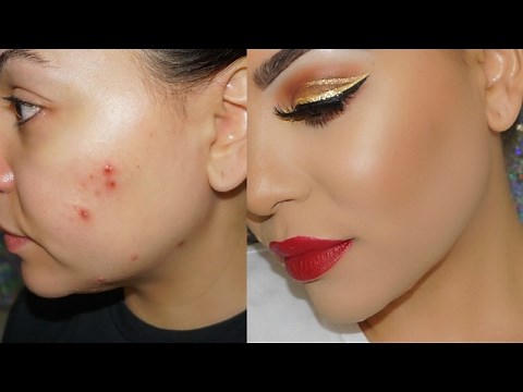How to Cover Acne & Scars with Makeup ! Cystic Acne & Acne Scars !