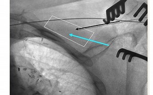 CRT治疗心衰的机制及进展