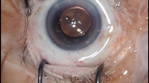Cataract surgery with Trifocal IOL Rayner RayOne