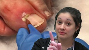 😊 Meta-Seven (30 Day): https://amzn.to/2EVFADz 😊 Meta-Seven (90 Day): https://amzn.to/2Wh2Hys 😊 Dr. G's Blackhead Tools: https://amzn.to/2Wjdo3B 😊 Coco Skin Plus: https://amzn.to/2WsdhHB 😊 Meta-Seven (360 Day): https://amzn.to/2MwU8A0 Dr. Gilmore's Store: http://www.shopgilmore.com http://www.meta-seven.com In this video you are watching documentary (reality) footage of Dr. G working in his clinic in the Houston area. This content is provided to help encourage medical discussion and educati