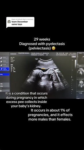 Understanding Pyelectasis in Babies During Pregnancy