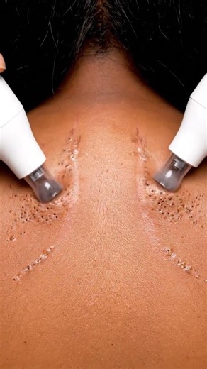 Satisfying Blackhead Vacuum ASMR