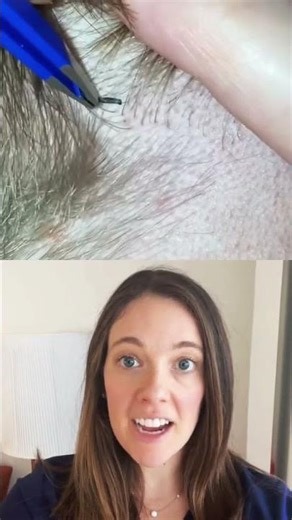 Extraction of a hair splinter