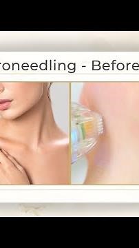 Before and After - RF Microneedling Treatment With Morpheus 8 Body