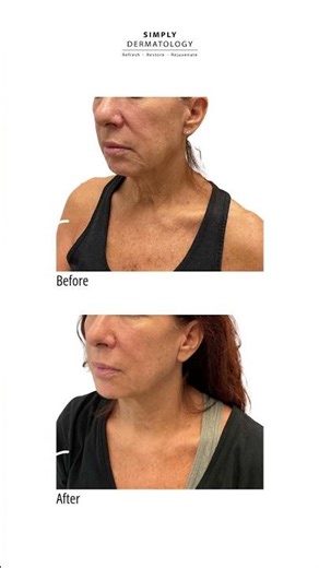 Lift Without Surgery | Simply Dermatology | Dr Kally Papatoniou