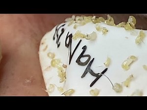 Loan Nguyen Acne (#072)