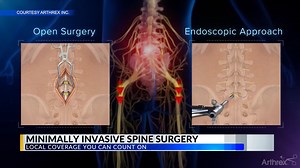 A steady wave of neuro and ortho spine surgeons are transforming their practice to offer ultra-minimally invasive endoscopic treatment options designed to restore function, preserve motion, and minimize pain. Dr. Mark A. Prevost II, MD, was recently featured in a story on Birmingham’s CBS 42, highlighting the advancements in spinal endoscopy and sharing his excitement for bringing these innovative techniques to his hometown. Don’t miss the opportunity to sign up for one of Arthrex’s endoscopic s