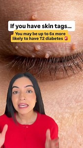Skin tags can make you up to 6X more likely to have Type 2 Diabetes? 🤯 We often ignore them or think they are just cosmetic annoyances, but they are actually a loud warning signal from your body. Here is the science: High insulin levels act like “fertilizer” for your skin cells, causing them to grow out of control. The scariest part? You can have high insulin levels for YEARS while your blood sugar tests come back “normal.” By the time your blood sugar rises, the damage has already been brewing