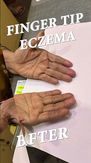 Treatment of Finger tip eczema | By Dr. Uttam Kumar Lenka MBBS, MD (Consultant Dermatologist)