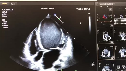 Understanding Spontaneous Contrast in Echocardiography | Mauricio Higashi posted on the topic | LinkedIn
