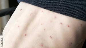 Close-up Kid Back with Rash of Itchy Inflamed Blisters. Chickenpox Infected Boy. Child Disease. 2x Slow motion 60 fps 4K