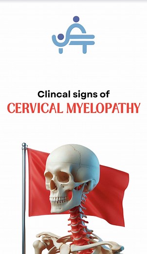 Recognizing Cervical Myelopathy Signs in Clinical Practice