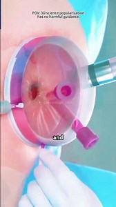 Hysterectomy Procedure 3D Animation