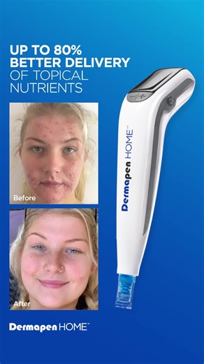 Transform your skincare routine with Dermapen HOME™. Our advanced microneedling device creates flawless, fractional micro-injuries to stimulate your skin’s natural healing, reduce problematic skin, and boost collagen production. Embrace visibly smoother, more vibrant skin right from the comfort of your own home. | DermapenWorld
