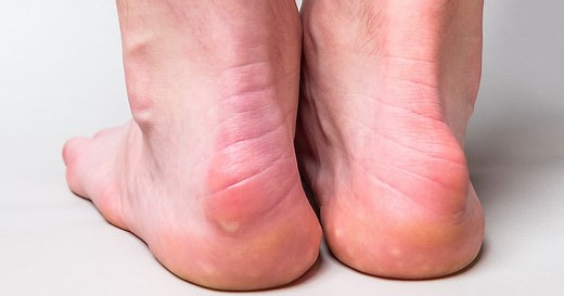 Haglundferse: Alles zu Ursache, Behandlung und Rückbildung