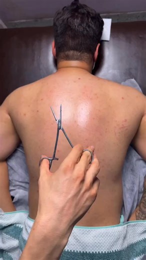 Fire Cupping is an ancient technique used in traditional Chinese medicine that involves placing heated glass cups on the skin to create suction. This suction helps stimulate blood flow, loosen tight muscles, and encourage lymphatic drainage. Though it leaves circular marks, it’s generally painless and deeply relaxing. 🔥🩵 While we don’t perform fire cupping at our clinic, it’s an incredible modality practiced by skilled professionals—and we love seeing this kind of work shared! #FireCupping #Ci