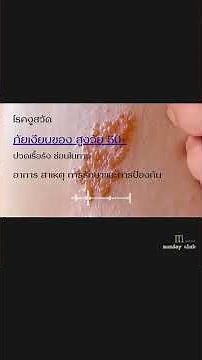 โรคงูสวัด อาการ สาเหตุ การรักษาและการป้องกัน