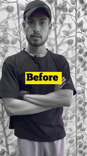 Hakim Abdul Rahim | Men's Power on Instagram: "Just 15 days result in AVN Problem by Naturopathy treatment Avascular necrosis (AVN), or SALTHY HIP JOINT osteonecrosis, is a serious, progressive bone condition where reduced blood supply causes bone tissue to die and potentially collapse, typically in the hip, knee, or shoulder. It causes significant pain, limited mobility, and, if untreated, can result in joint destruction and disability. AVASCULAR NECROS, Key Details About AVN: Causes: Common ca