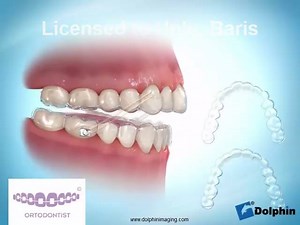 orto-aligners are invisible and easy to use with cerec ortho. scan your cases with cerec ortho 1.1 and send it to us, get your aligners in 7 working days | Lingual ortho