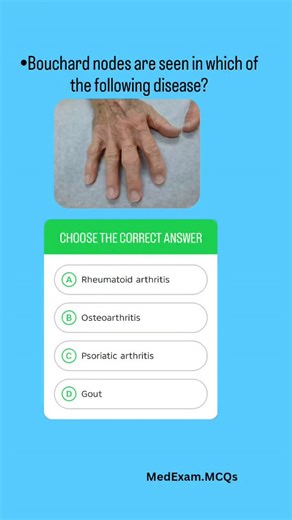 Medical Exam MCQs on Instagram: "Explanation:⤵️ *Correct Answer is B (Osteoarthritis) 🔷A. Rheumatoid arthritis: Shows PIP swelling, but classic nodules are on elbows, not Bouchard nodes. 🔷B. Osteoarthritis: Correct, Bouchard nodes = Proximal Interphalangeal (PIP) joint bony enlargements in OA. 🔷C. Psoriatic arthritis: Causes dactylitis and nail changes, not Bouchard nodes. 🔷D. Gout: Shows tophaceous deposits, usually in big toe, not PIP bony nodes. #usmle #medicine #neetpg #medico #medical #